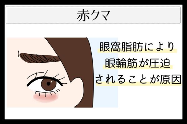 目の下のクマには種類がある? 見分け方や原因、種類別の対策を詳しく解説!の画像