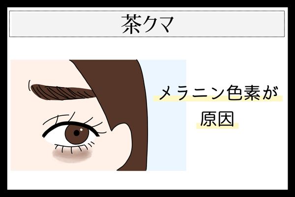 目の下のクマには種類がある? 見分け方や原因、種類別の対策を詳しく解説!の画像