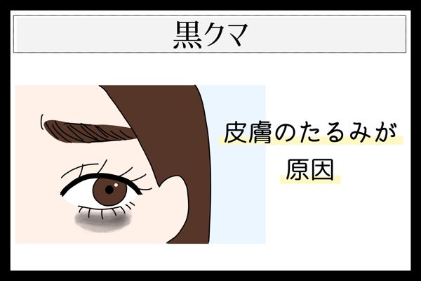 目の下のクマには種類がある? 見分け方や原因、種類別の対策を詳しく解説!の画像